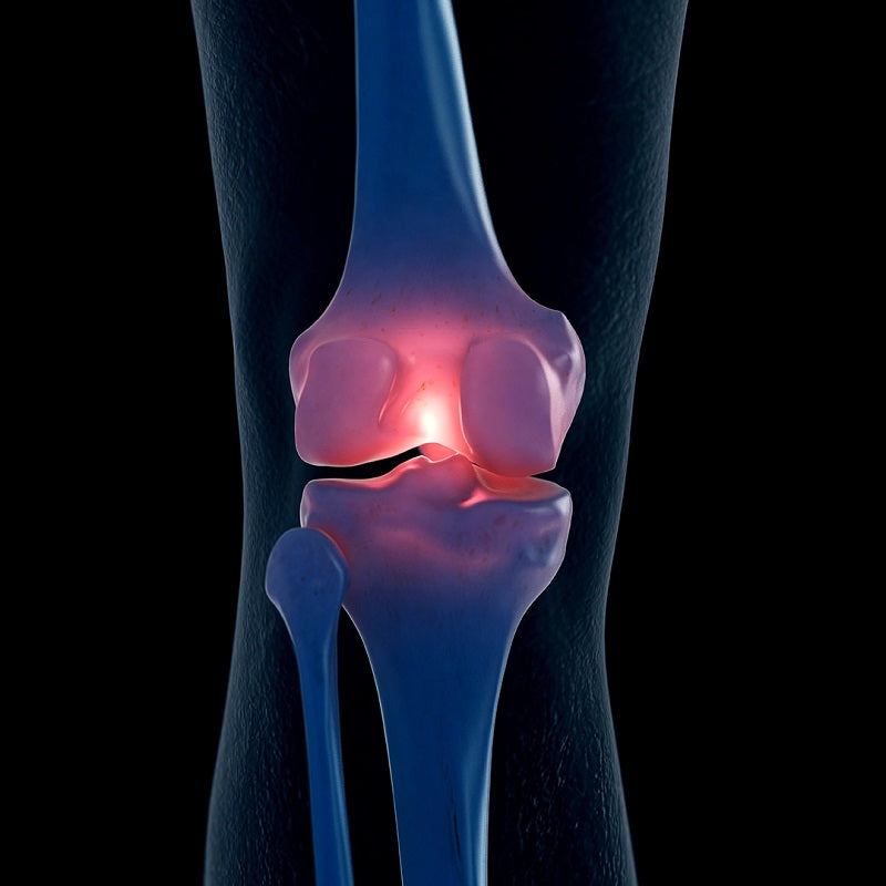 Image of a knee joint with Osteoarthritis.