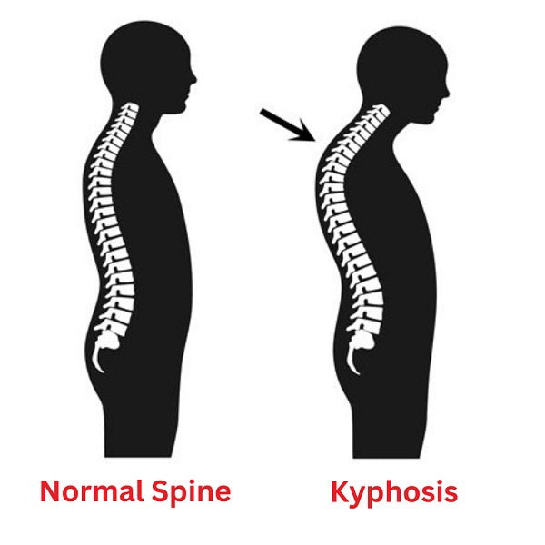 Image of a human spine affected by Kyphosis.