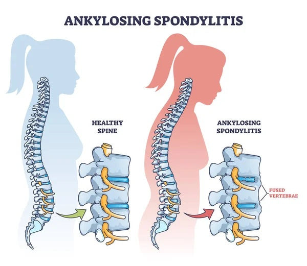 Graphic showing the effects of ankylosing spondylitis