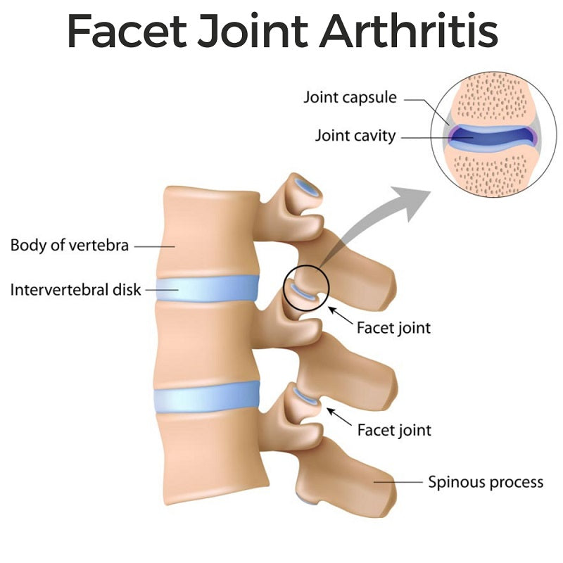What You Need to Know About Facet Joint Arthritis: Symptoms, Diagnosis, and Treatment