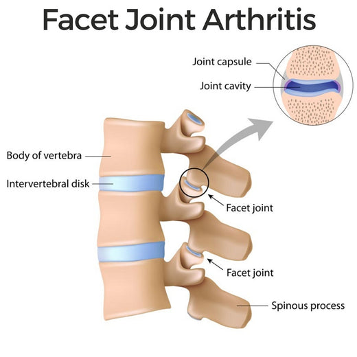 What You Need to Know About Facet Joint Arthritis Symptoms, Diagnosis
