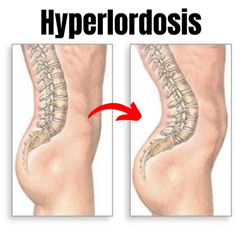 Understanding Hyperlordosis: Symptoms, Causes, and Treatment Options