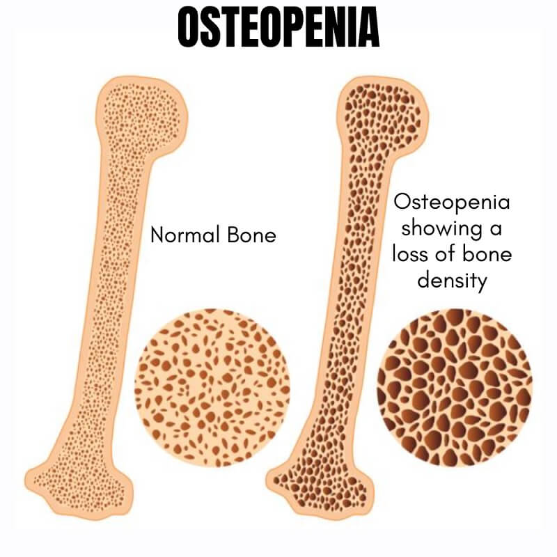 Osteopenia It s Causes Symptoms And Treatment OrthoRelieve osteopenia-it-s-causes-symptoms-and-treatment-orthorelieve