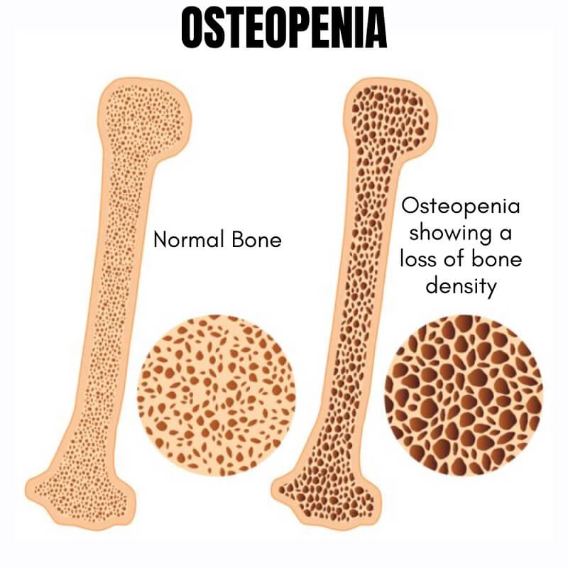 A graphic comparing the bone density loss in a normal bone and the bone of a osteopenia patient.
