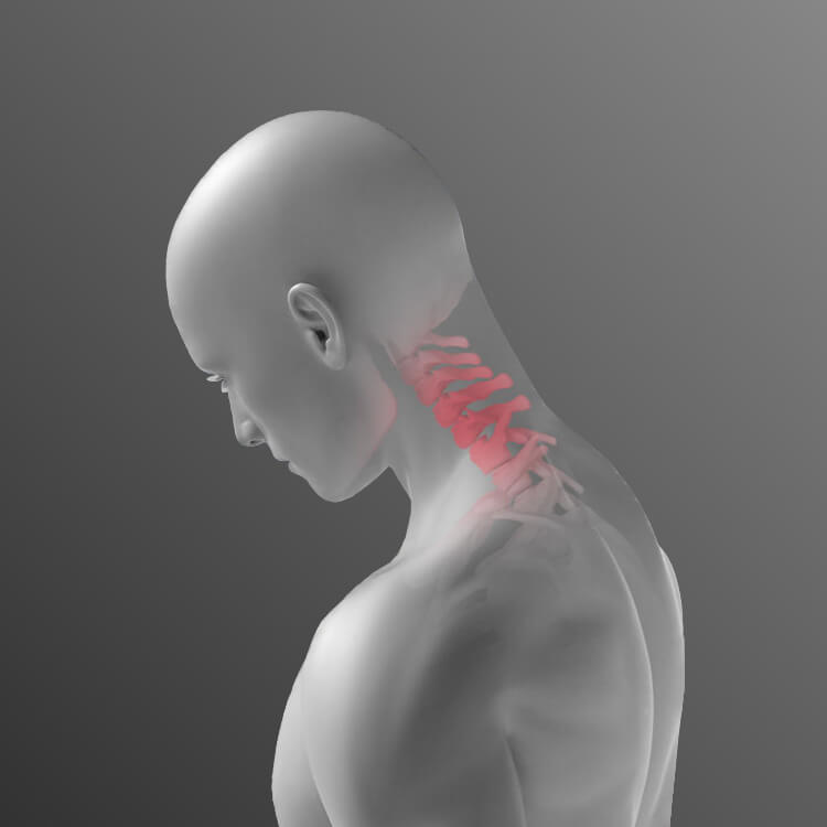 Graphic of sore neck along the cervical spine.